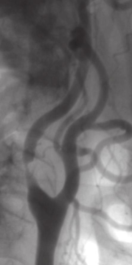 stenose interna a communis externa c filter katheter stent b Angiogrammen van een 75-jarige man, (a) met een symptomatische en aanzienlijke stenose in de interna, (b) direct na stentplaatsing met