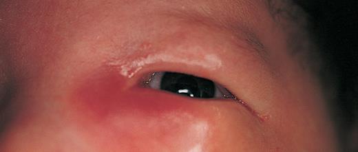 Ogen Milde zwelling van oogleden eerste dagen na geboorte is normaal