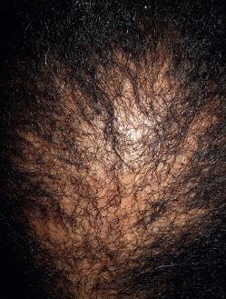 Centrale centrifugale cicatriciële alopecia (CCCA) Epidemiologie: M.n. bij mensen van negroide afkomst Klinisch - Chronisch progressief - M.