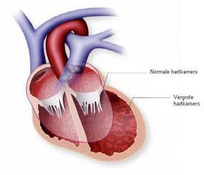 Hartfalen Hartfalen is het onvermogen van het hart om voldoende bloed rond te pompen. Dit kan allerlei oorzaken hebben.