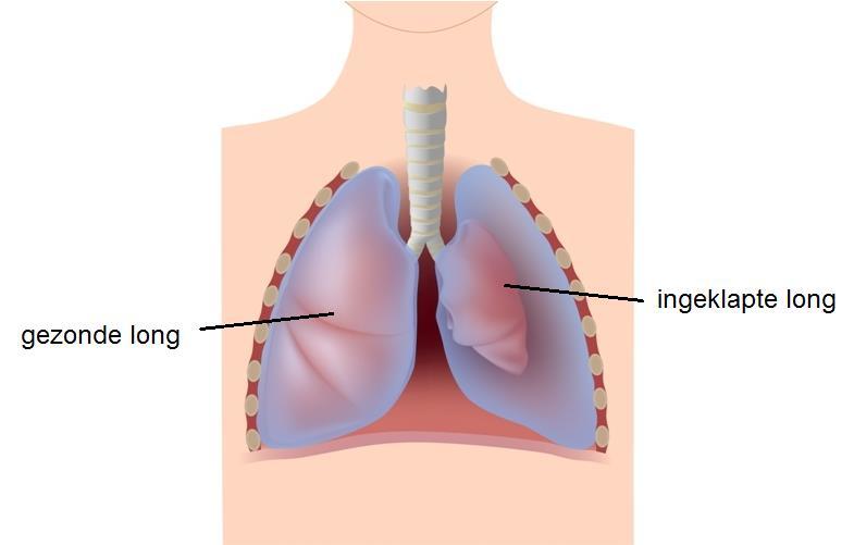 Inleiding U bent opgenomen met een ingeklapte long. Dit wordt een pneumothorax genoemd. In deze folder leggen we u uit wat een ingeklapte long precies is en hoe deze behandeld wordt.