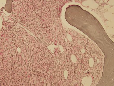 Myelofibrose symptomen: vermoeidheid, vermagering, abdominale pijn, kortademig,