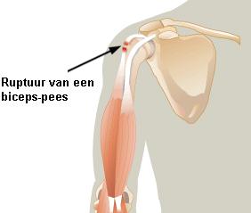 M Biceps brachii, caput longum, langekop O: