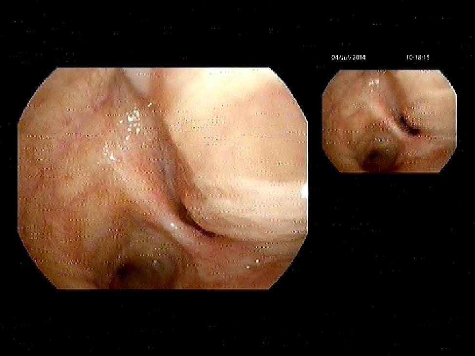 Casus Helaas - groei klier mediastinum - opname voor mediastinoscopie/ebus - daarna IC en MC Niet-necrotiserende granulomen passend bij sarcoïdose