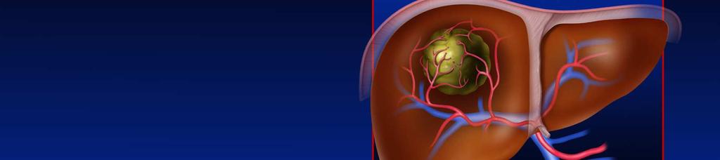 DUAL BLOOD SUPPLY OF LIVER De bloedvoorziening van een HCC komt van de hepatische arterie tgv neovascularizatie