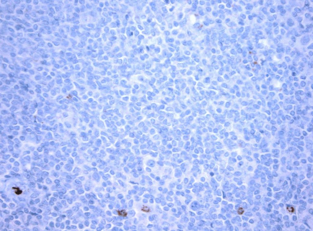 CD15 Tumor3 NLPHL Positief 2