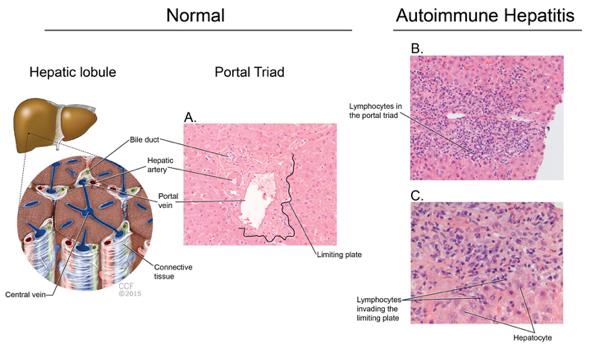 AIH: pathologie interface hepatitis (plasmo)lymfocytair