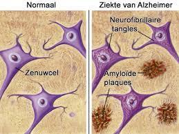 Pathofysiologie Alzheimer Amyloïde plaques en tangles van Tau-eiwit Al vroeg aantoonbaar in liquor Geen therapeutische consequenties, hooguit diagnostisch Farmagigant Pfizer stopt met onderzoek naar
