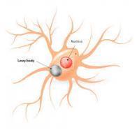 Lewy-body-dementie of Parkinson-dementie-complex Oorzaak: Lewy Bodies in hersenen