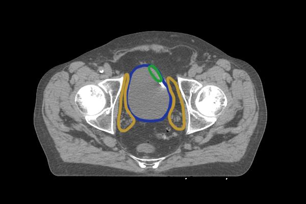 Adaptieve Radiotherapie