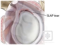 Labrum