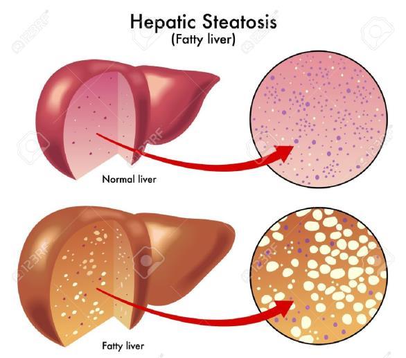 Conclusie NAFLD = serieus gezondheidsprobleem Screenen zinvol