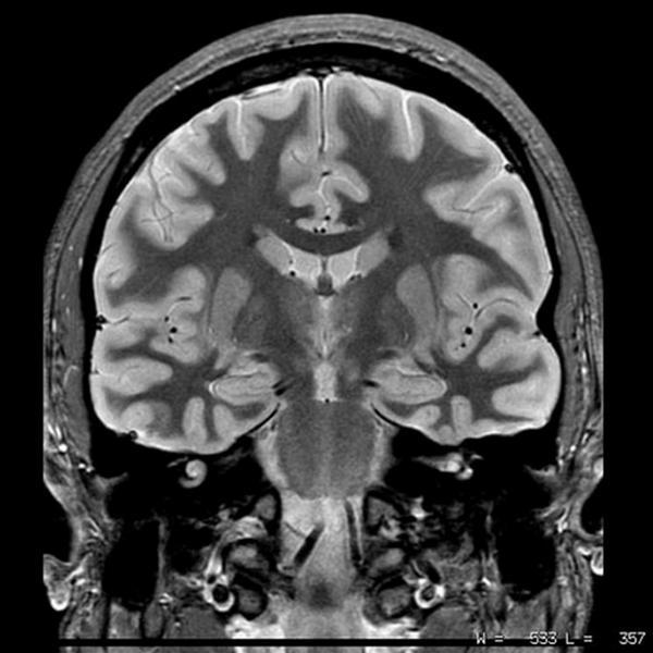 pagina 22 van 28 [Originele bron: galaxymri.net] Is de nucleus lentiforme (lenskern) zichtbaar in bovenstaande afbeelding van een coronale MRI van het hoofd? nee ja IF choice b.