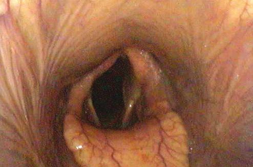 Afbeelding 12: Duidelijk doorhangen van het pharynxdak met name rechts, zichtbaar bij endoscopie van een paard met zwelling van de retropharyngeale lymfeknopen.