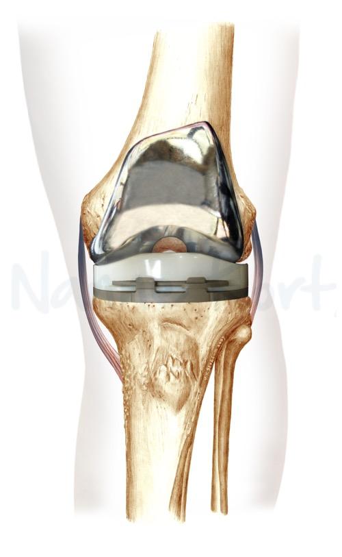 Folder Dr Kort Artrose van de Knie 5 / 5 Totale knieprothese Een totale knieprothese is een vervanging van het versleten kniegewricht, waarbij de onderkant van het dijbeen wordt vervangen en de