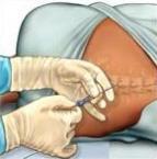 Daarna schuift de arts op deze plaats door een andere naald een klein slangetje (katheter) tussen de wervels in de epidurale ruimte.
