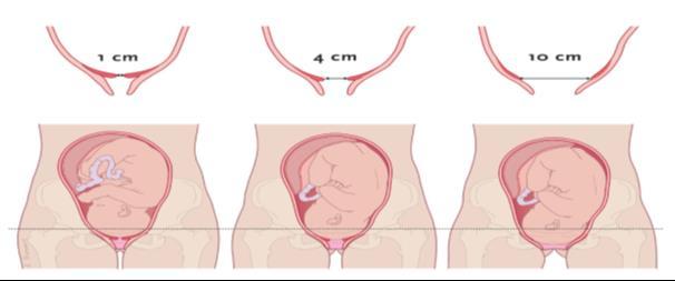 Verloop bevalling Het normale tijdstip van een bevalling ligt tussen de 37 en 42 weken. Het verloop is afhankelijk van vele factoren. Een eerste bevalling duurt vaak langer dan een volgende.