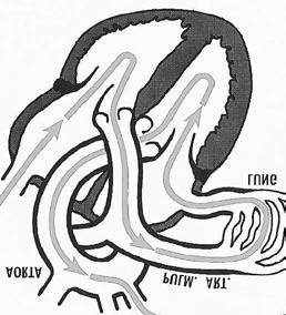 Arteria Pulmonalisklep Aortaklep Tricuspidalisklep Mitralisklep 2.4 Hartkleplijden Wat is hartkleplijden?