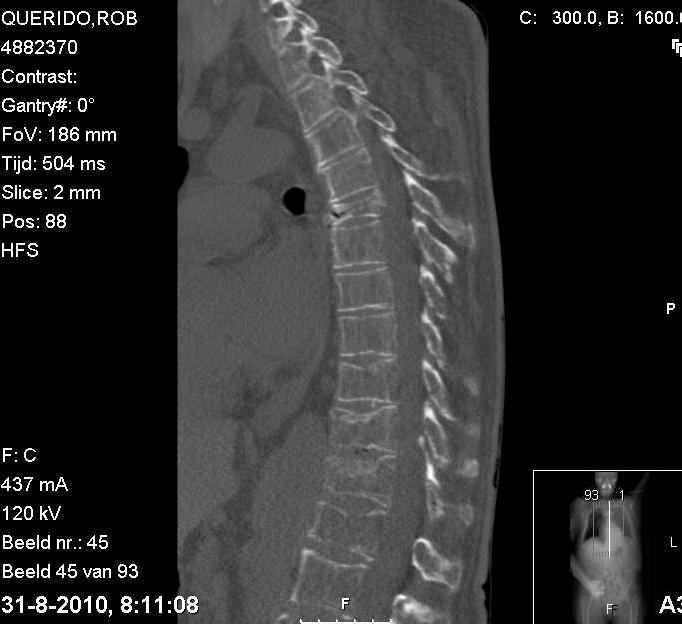 8 cm loss in height