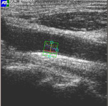 carotid bulb in 236 middle-aged