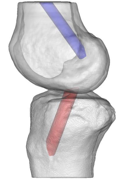 2 Studie over de reconstructie van de voorste kruisband Voor de studie over de reconstructieve technieken werd, na berekening van de 3D beelden van de femur, tibia, femorale