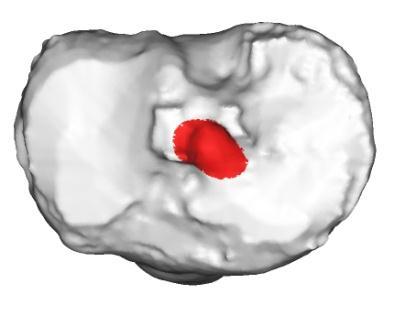 (tabel 13) De best-fit cylinder van de tibiale tunnel (inclusief schroef) had een gemiddelde diameter van 9.8554 mm (range 9.06 11.04 mm, SD ± 0.63395).