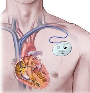 Via een ader onder het sleutelbeen worden de elektrodedraden van de pacemaker naar het hart opgevoerd.