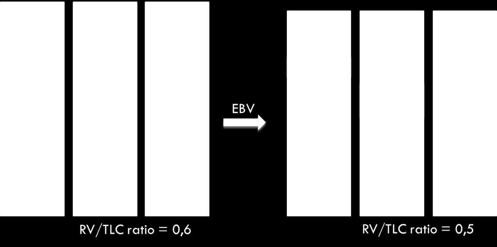 middenkwab Pre EBV Post EBV Vervangen van dode ruimte (RV) door