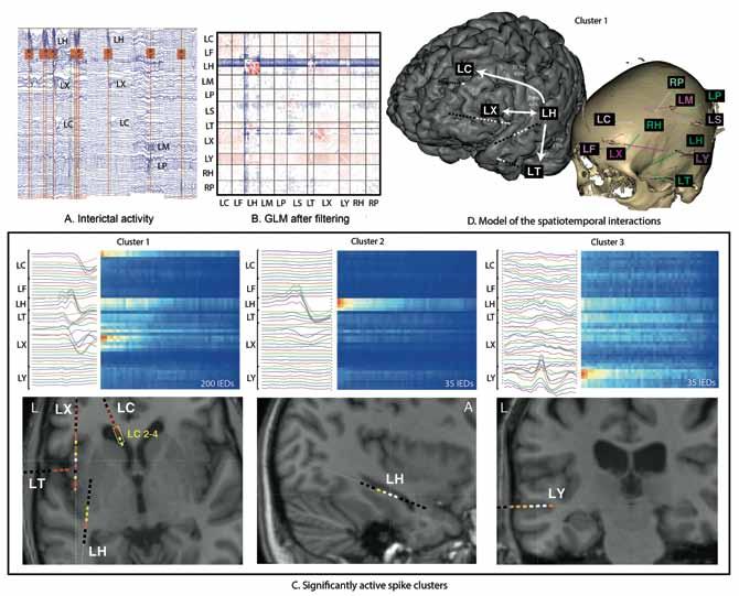 Figuur 1A: Interictale epileptiforme ontladingen in het EEG.