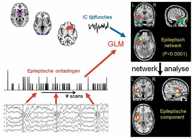 Combinatie van EEG en fmri Epileptische ontladingen zijn niet zichtbaar in fmri, maar wel in het EEG, ook als er geen klinische verschijnselen zijn, zoals bij een epileptische aanval.