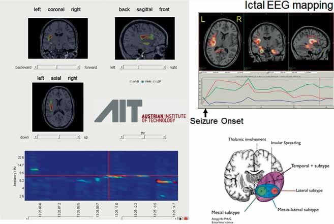 Figuur 3 De frequentie in het EEG als functie van de tijd met daarin zichtbaar het dominante frequentiegebied tijdens het begin van de epileptische aanval rond 8 Hz (linksonder).