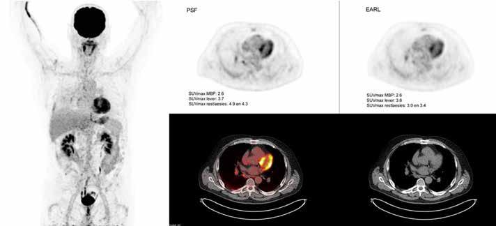 A Figuur 2. Patiënt van 63 jaar met een klassiek Hodgkin lymfoom. A. Baseline 18 F-FDG PET/CT scan ter stadiëring. B. 18 F-FDG PET/CT scan in het kader van responsbeoordeling na vier kuren ABVD. A. PSF reconstructie: SUV max mediastinale bloedpool (MBP) 2.