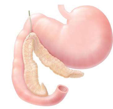 Acute pancreatitis Acute pancreatitis wordt vaak veroorzaakt door een blokkade van de alvleesgang. Deze obstructies worden vaak veroorzaakt door galstenen.