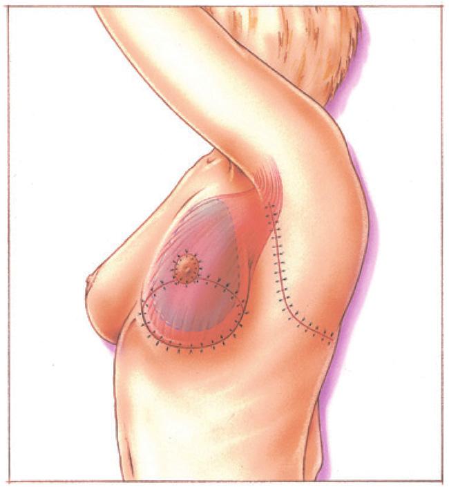 Als er na een borstamputatie weinig goed doorbloed weefsel is overgebleven, kan het voorkomen dat de operatiewond moeilijk wil genezen.