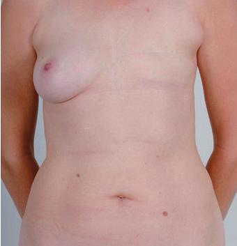 Voordelen van de TRAM of DIEP-methode Een voordeel van de DIEP en TRAM-methode is dat de plastisch chirurg meestal voldoende huid- en vetweefsel heeft om de vorm en consistentie van de andere borst