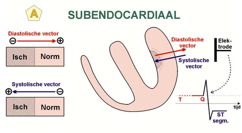 Ischemische veranderingen in het ST-segment Subendocardiale