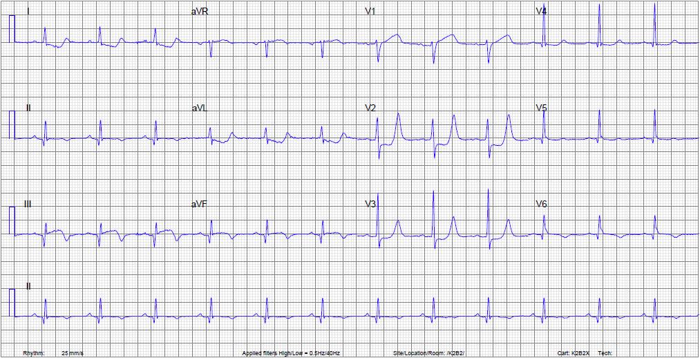 ECG Protocol Stap 1: Interpreteerbaar volledig ijking? Stap 2: Artefacten? Stap 3: Ritme: sinus regelmaat hartfrequentie?