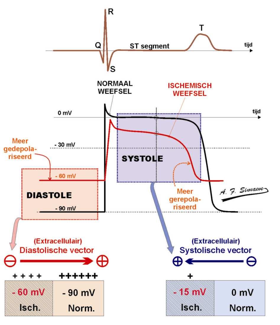 Ischemische lesie stroom Algemeen principe DIASTOLISCHE