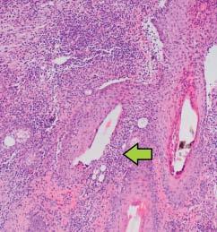 Figuur 5B. Figuur 6. Folliculitis ( acne ) keloïdalis. Kliniek Aan de achterste helft van de scalp multiple nodi, deels fluctuerend en pusproducerend (figuur 7).