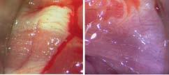 preselectie van hiv-positieve MSM die HRA moeten ondergaan. [5] A. Condylomateus; LGAIN. C. Hyperkeratotische leukoplakie en punctatie; HGAIN. B. Condylomateus; HGAIN. D.