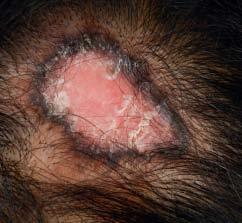 Cicatriciële alopecie Klinische en histologische diagnostiek R.