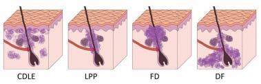 Zonder stamcellen kan de aangedane haarfollikel niet meer regenereren en gaat te gronde, inclusief de geassocieerde talgklieren.