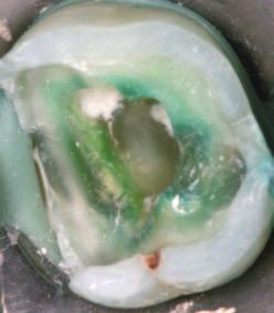 Thema: Endodontologie 1 a b c d Afb. 4. Fasen van vullen en restaureren van tijdelijke gebitselementen na endodontische behandeling.
