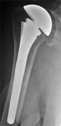 Dit betekent dat de schouderprothese dezelfde bouw heeft als een normaal schoudergewricht.