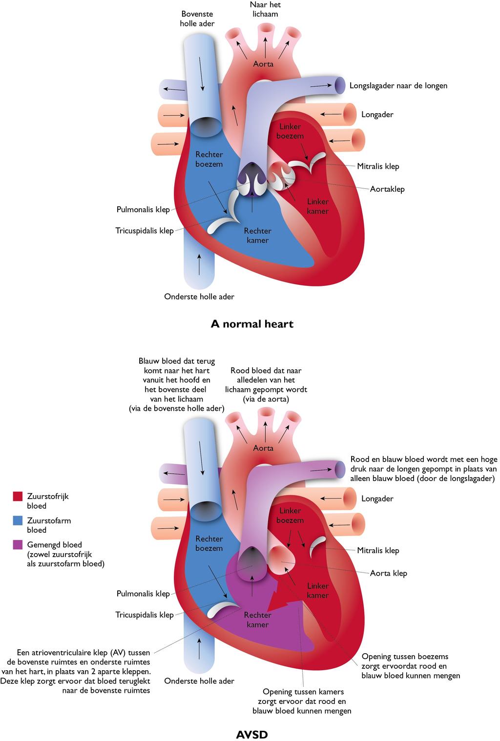 8 Ventrikel septum defecten (VSD s) Dit zijn gaatjes in het tussenschot tussen de kamers van het hart.