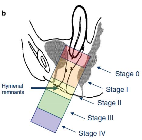 GENERAL INTRODUCTION AND OUTLINE OF THE THESIS Point Aa Ba C gh pb tvl Ap Bp D Description Anterior vaginal wall 3cm proximal to the hymen Most distal portion of the anterior vaginal wall Most distal