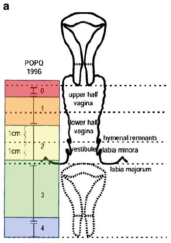 Total vaginal length depth of vagina when point D or C is reduced to normal position Posterior vaginal wall 3 cm proximal to the hymen Most distal portion of the posterior vaginal wall Posterior