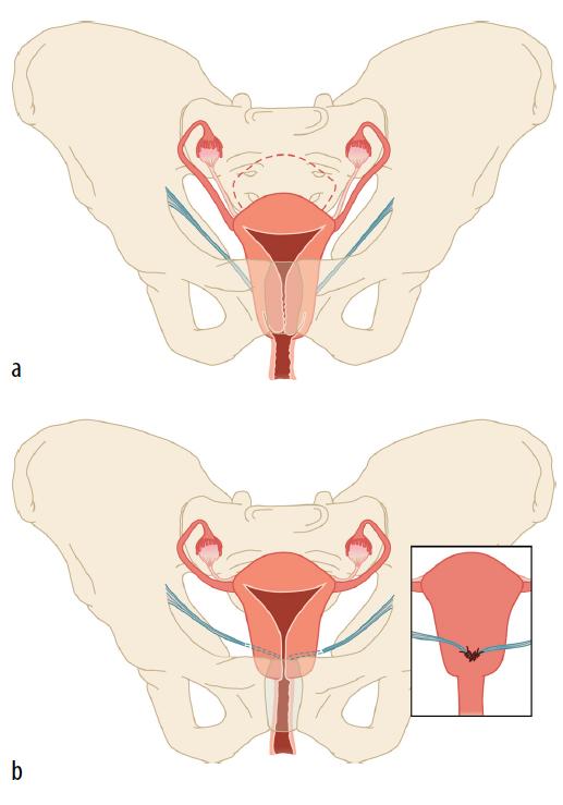 CHAPTER 2 FIGUUR 2. (a) Descensus uteri vóór een operatieve ingreep. De oorspronkelijke positie van de uterus is met een rode stippellijn aangegeven.