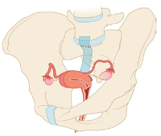 CHAPTER 2 FIGUUR 4. Abdominale hysteropexie. Hierbij wordt de uterus laparoscopisch of tijdens laparotomie met behulp van een kunststofmatje aan het sacrum gefixeerd.