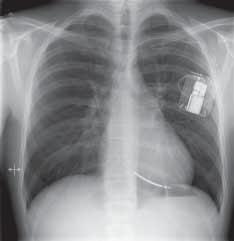 Hij slaat ook gegevens op in een geheugen. 2) De leads : één of meerdere draden verbinden de defibrillator met het hart. Zij worden naar het hart geleid via een ader.